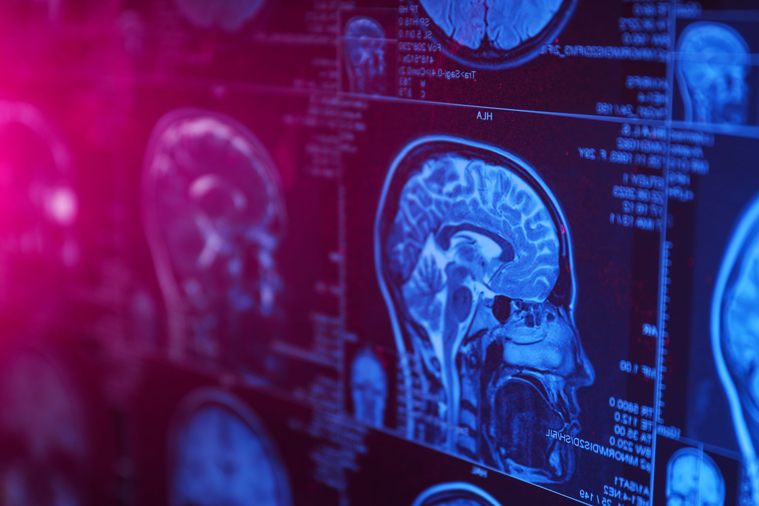 k_mri-or-magnetic-resonance-imaging-of-the-head-and-2023-11-27-04-52-34-utc